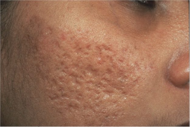 Cystic tuberous Acne Cystic tuberous Acne