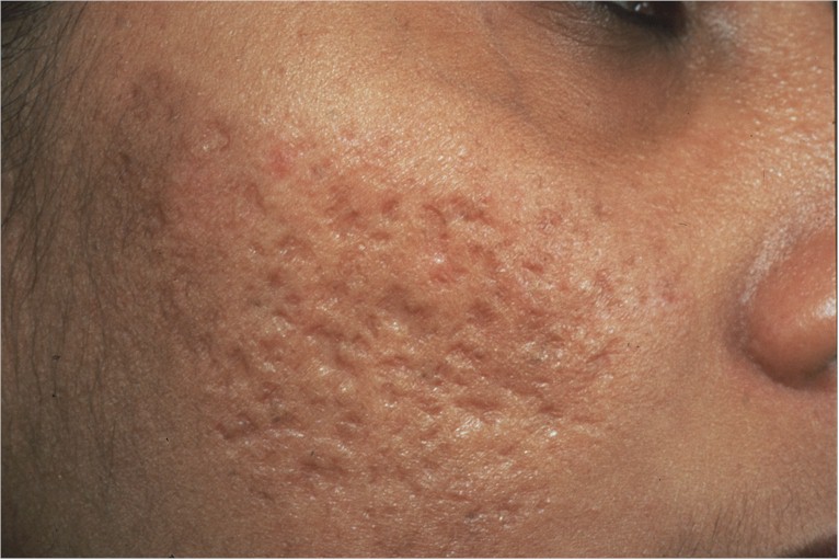Cystic tuberous Acne Cystic tuberous Acne