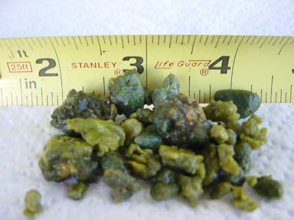 gallstones-c