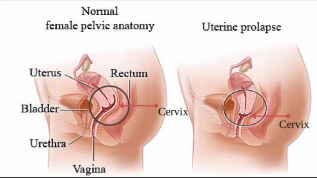 uterine prolapse, prolapsed uterus uterine prolapse, prolapsed uterus