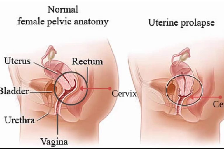 uterine prolapse, prolapsed uterus uterine prolapse, prolapsed uterus