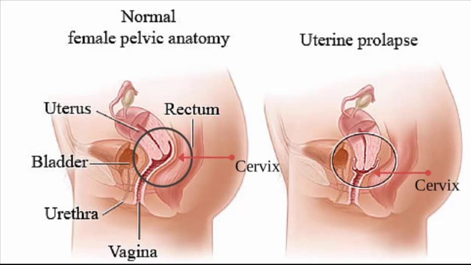 uterine prolapse, prolapsed uterus