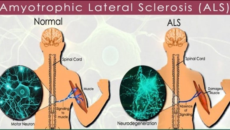 ALS: What Is Lou Gehrig's Disease? - University Health News