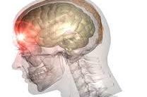 Concussion Concussion