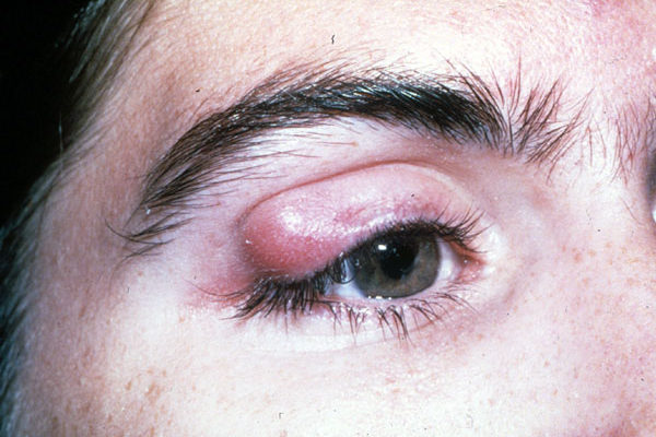 chalazion, stye