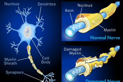 multiple-sclerosis-demyelinization