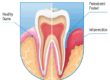 periodontal-disease