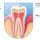 periodontal-disease