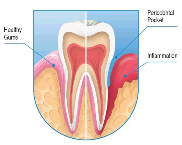 periodontal-disease periodontal-disease
