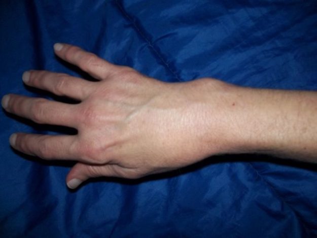 Broken Wrist Broken Wrist
