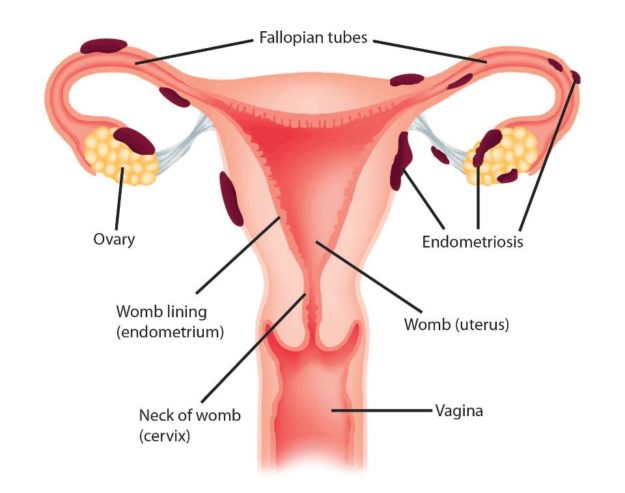 Endometriosis Endometriosis