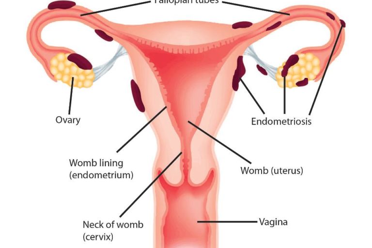 Endometriosis Endometriosis