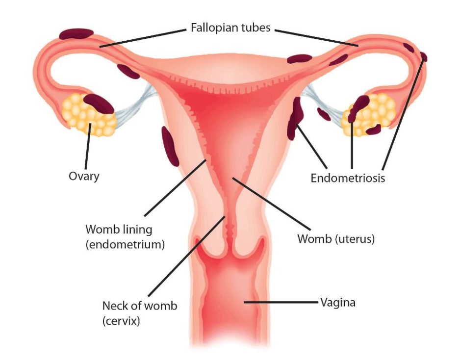 Endometriosis