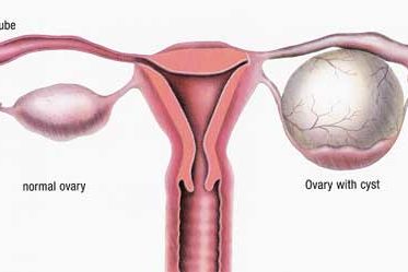 Ovarian Cyst Ovarian Cyst