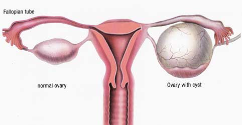 Ovarian Cyst Ovarian Cyst