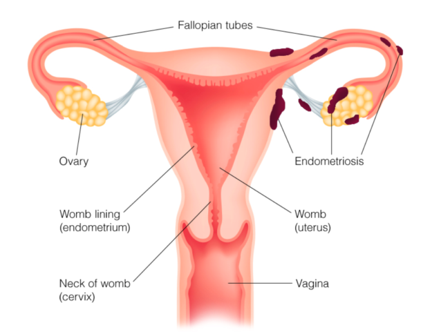 homeopathictreatmentendometriosis homeopathic treatment endometriosis
