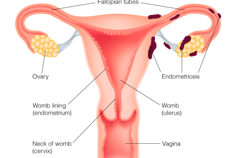 homeopathictreatmentendometriosis homeopathic treatment endometriosis
