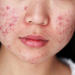 Alternative treatment for acne