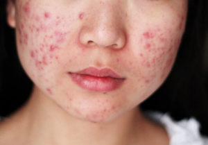 Alternative treatment for acne