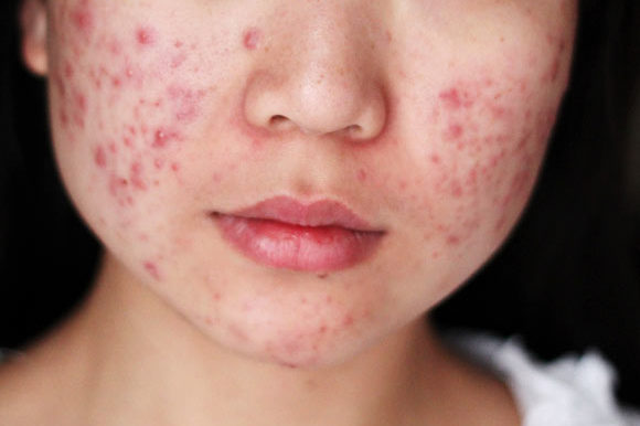 Alternative treatment for acne Alternative treatment for acne