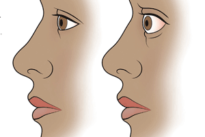 GravesDiseaseBasedow300px