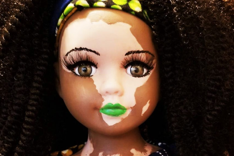 homeopathic treatment vitiligo