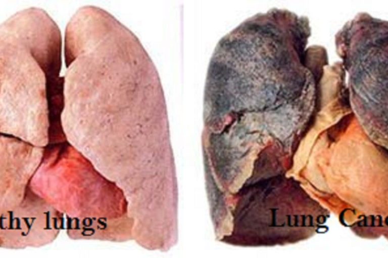 alternative treatment Lung Cancer alternative treatment Lung Cancer