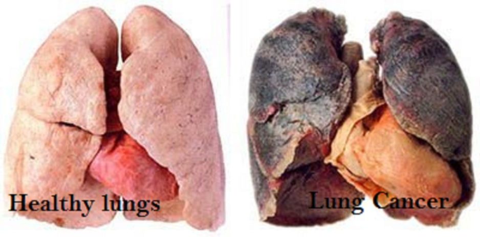 alternative treatment Lung Cancer